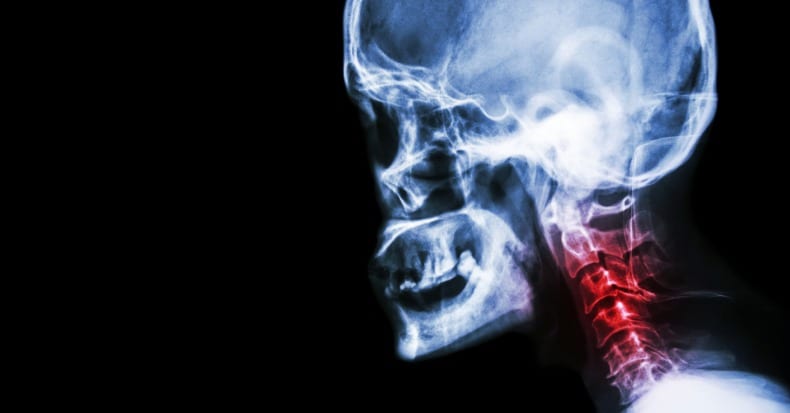 Cervical Spondylosis and Neck Pain