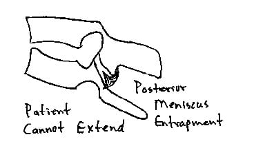 Posterior meniscus entrapment