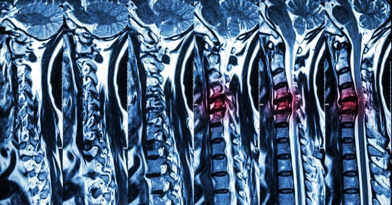 Spinal Segmental Spondylosis