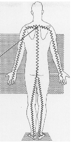 Spinal cord compression