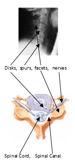 Neck pain