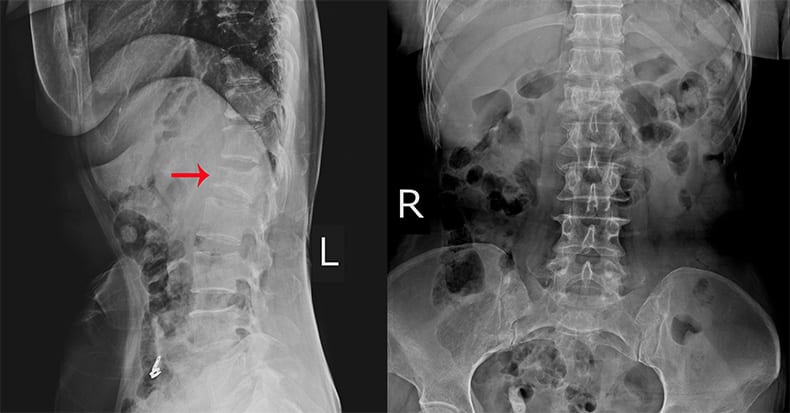 Spondylolysis and Anterior Spondylolisthesis