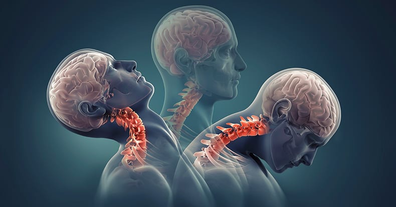 New Understanding of Whiplash-Injury Chronicity