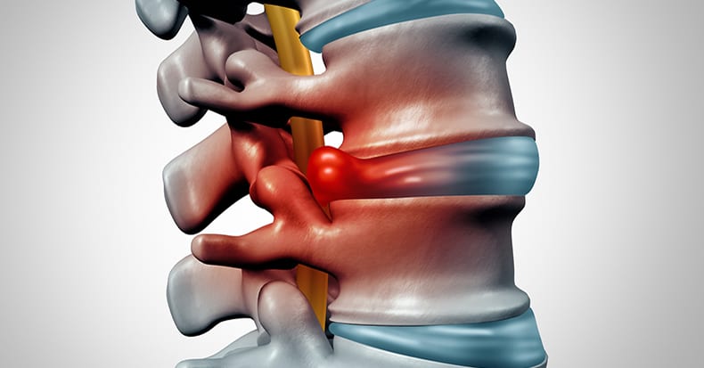 Lumbar Spine Herniated Intervertebral Disk with Discogenic Radiculopathy/Sciatica