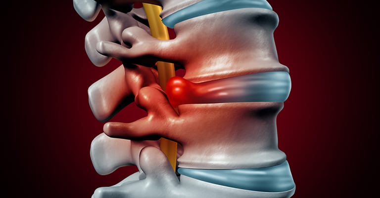 Herniated Low Back Disc and Low Back Manipulation