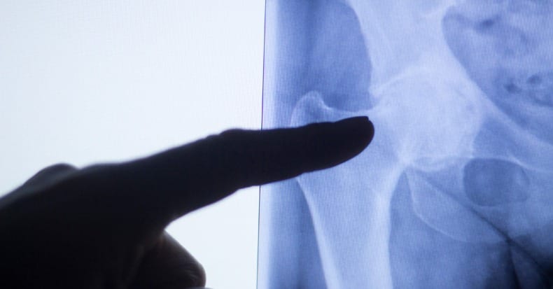 Hip joint replacement impant xray test scan results of old aged