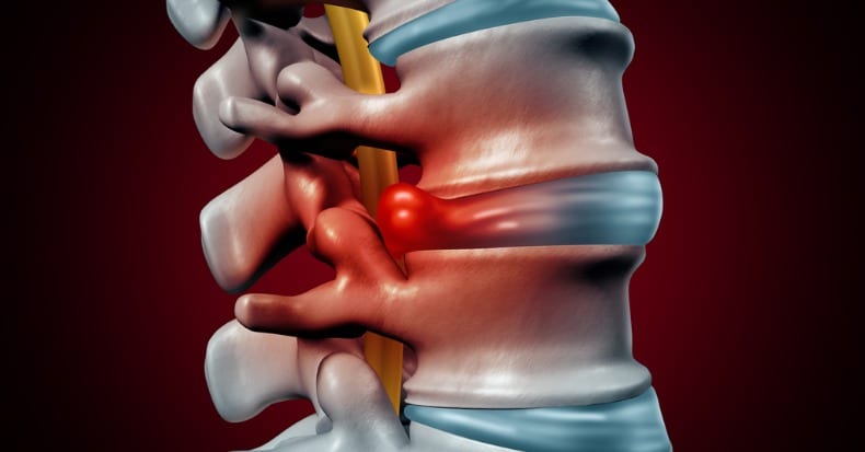 Lumbar Disk Herniation Size and Surgery