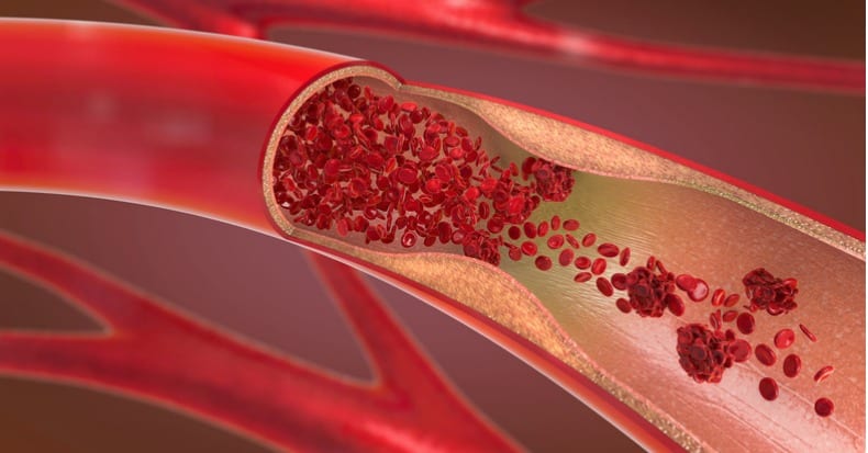 3d illustration of a constricted and narrowed artery and the blood