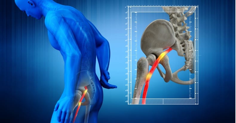 The Lower Back, Leg Pain, and Sciatica