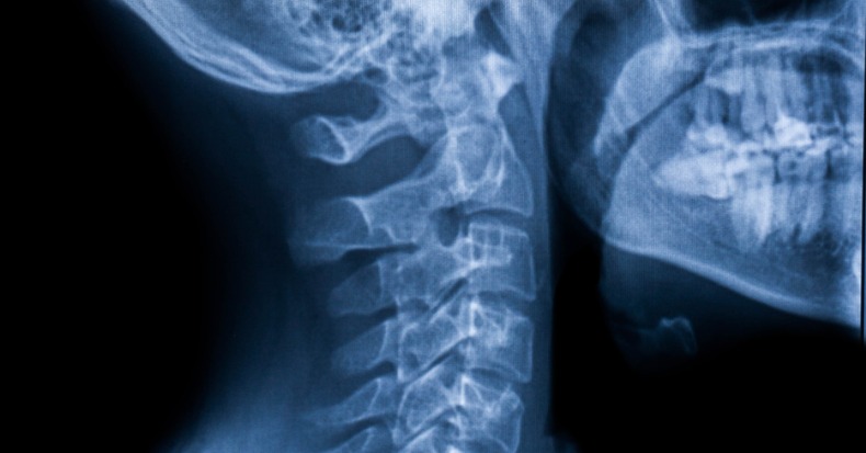 Useful Tests for Diagnosing Whiplash