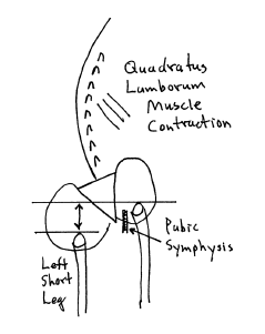 Chronic contraction quadratus lumborum