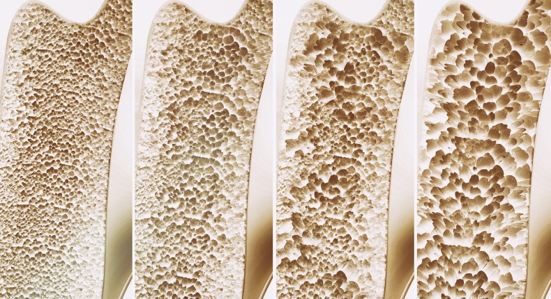 Osteoporosis 4 stages 3d rendering